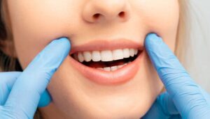 Clareamento Dental Chaude Odonto Águas Claras DF